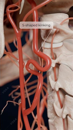 Pathological Carotid Artery Tortuosity: Abnormal Vessel Curvature in 3D