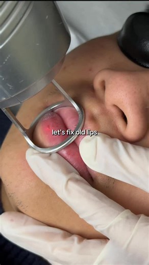 How to fix your damaged lips 👄 using the Co2 Laser! #london #hyperpigmentation #viral #reel #lips | Blueness By Oceania Aesthetic Clinic