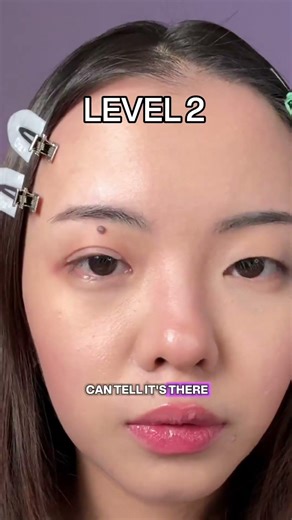 3 level of eyelid surgery✨