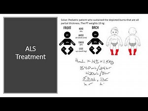 Pediatric Shock - Burns
