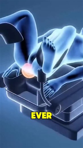 Sachin Singh Negi on Instagram: "Anal Fistula Surgery 3D Animation fistulas fistulasurgery it's reels for education purpose only ❤️‍啕 #fistula #medstudents #viral #trending #explore #reelsinstagram #shorts #healthcare #explorepage #sachinsinghnegiofficial #medicalknowledge #animation #surgery #pregnancy #occurs"