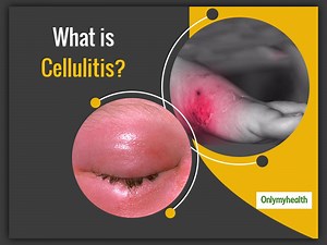 What Is Cellulitis Disease: Causes, Symptoms, Diet And Treatment