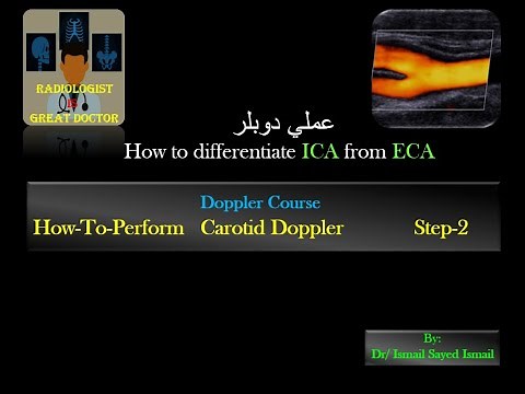 How-To-Perform Carotid Doppler Step-2 (Differentiate ICA from ECA)