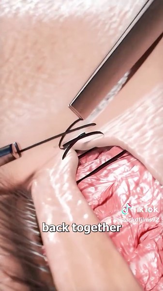 How Double Eyelid Surgery Works 😮 | monolid eyes