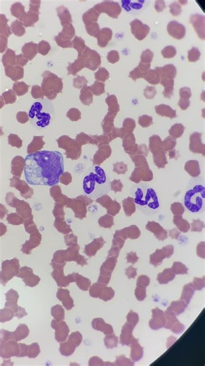 Mustafa Elsobky on Instagram: "Blood smear cytology of FIP 🐈 / Absolute Neutrophilia / Rouleaux formation of RBC’s “ Hyperglobulinemia” / Monocyte with vacuolated Cytoplasm / Reactive lymphocyte ✨🔬"