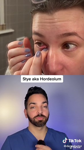 Stye Treatment: DermDoctor's Reaction and Tips