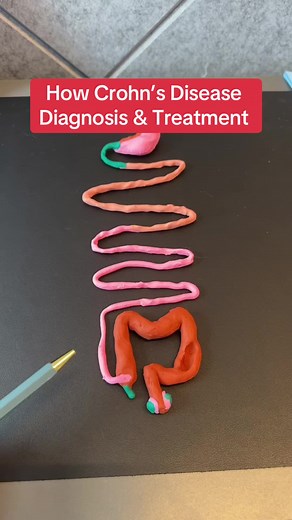 Crohn’s Disease: Diagnosis & Treatment