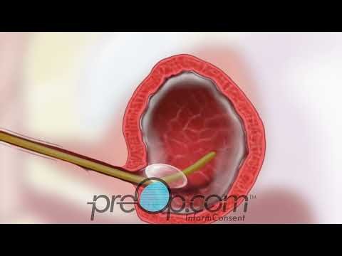 TURBT Bladder Tumor 💙 #preop #bladder PreOp® Patient Education