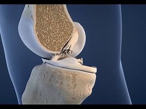 Kreuzbandriss Medizinische 3D Animation