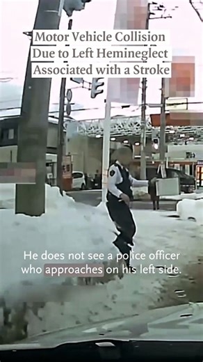 🧠 MedicalCortex 🩺🩹 on Instagram: "Left hemineglect usually comes from a right parietal lobe stroke. That area isn’t just about seeing—it’s about attention, awareness, and reality-checking. So the patient: Can technically see (eyes + primary visual cortex work) But does not attend to the left side of space And crucially, isn’t aware that they’re ignoring it This combo leads to the classic “I’m totally fine, why are you asking?” response. Basically You don’t know you can’t see the left—because