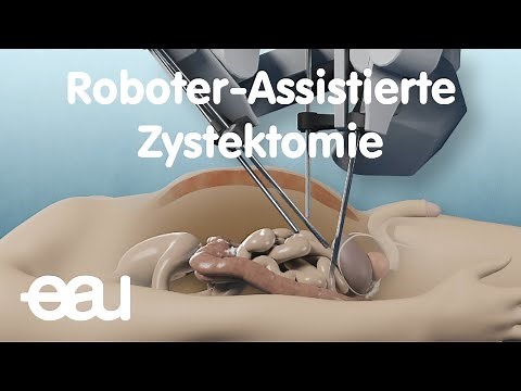 Roboter-Assistierte Zystektomie