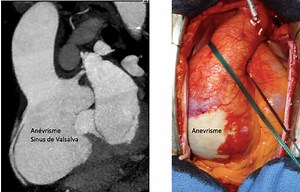 Aorte ascendante - Chirurgie cardiaque - Clinique Saint-Augustin, Bordeaux