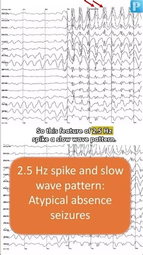 EEG Findings for Absence Seizures