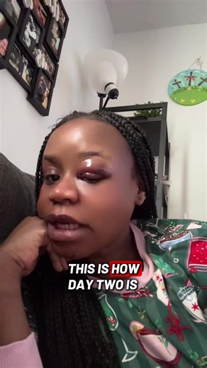 Post Eyelid Surgery Day 2: Managing Pain Levels