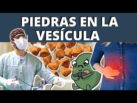 GALLSTONES (Cholelithiasis) - Causes? Symptoms? Treatment? Gallbladder issues