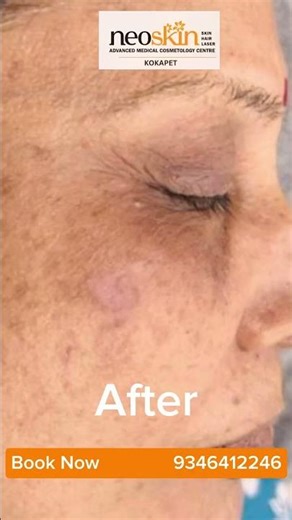 The Melasma Secret 🤫The medical-grade secret to clearing melasma for good. Neoskin Kokapet #kokapet