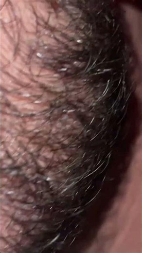 #blackheadcaique #pimple #oddlysatisfying #thebarbersarms #blackheads #satisfying #beard
