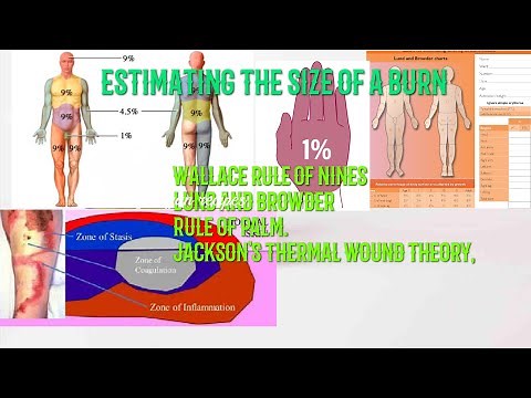 ASSESING THE SIZE OF A BURN, RULE OF 9's, LUND- BROWDER CHART, RULE OF PALM, JACKSONS THEORY.