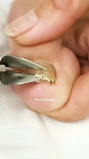 Toe Nail Clippers Remove Dead Skin Nail Correction Nippers Ingrown Toenail Cuticle Scissor Edge Manicure Nail Care#Toe #Nail #Clippers #Remove #Dead #Skin #Nail #Correction #Nippers #Ingrown #Toenail #Cuticle #Scissor #Edge #Manicure #Nail #Care