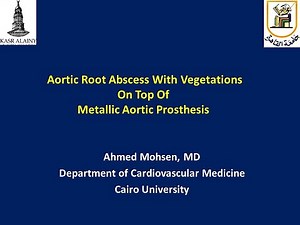 Aortic root abscess with vegetations on top of metallic aortic prosthesis