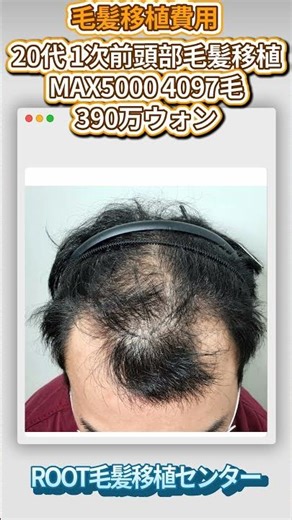 韓国毛髪移植、20代 1次前頭部毛髪移植MAX5000 4097毛390万ウォン#毛髪移植