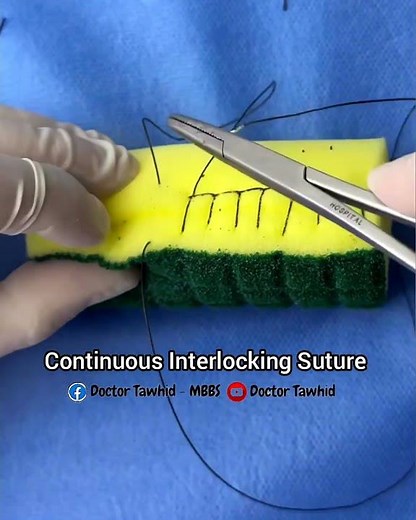 Continuous Interlocking Suture