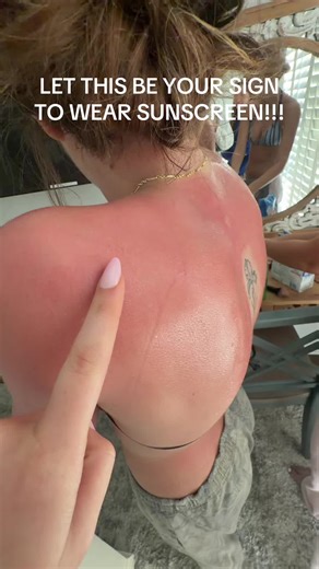Sunburn Awareness: The Importance of Sunscreen