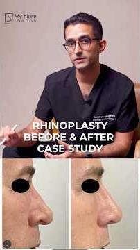 Rhinoplasty Before & After | My Nose London