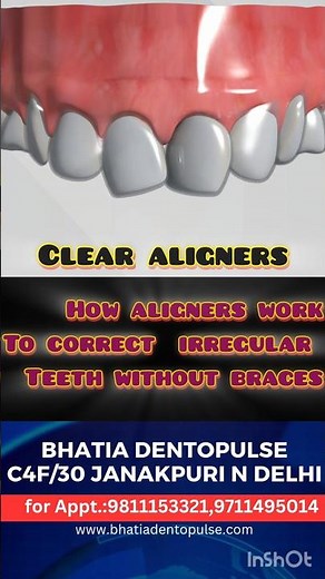 How Clear aligners work to straighten irregular teeth that without braces,Mechanism of aligners