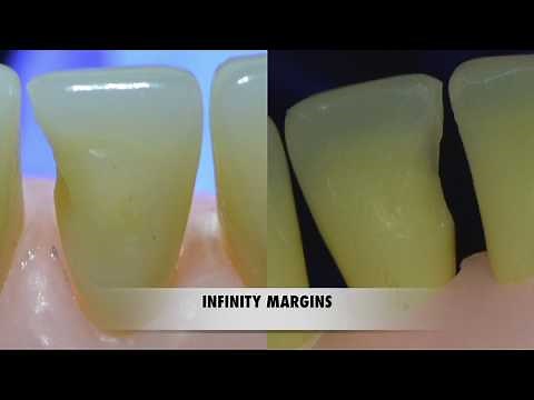 Class III cavity preparation for Resin Composite