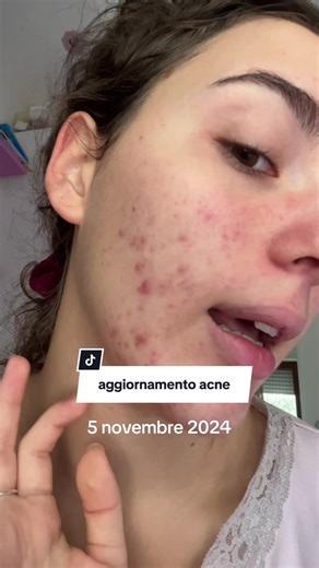 La mia lotta contro l'acne: prodotti coreani efficaci