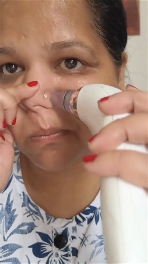 Affordable Blackhead Vacuum Review | Worth It? #skincare #trending #beauty #viral