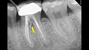 How To Extract A Lower Molar