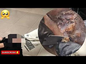 😱 Severe Jigger Attack – Rotten Foot Layers Removed! #MC1009