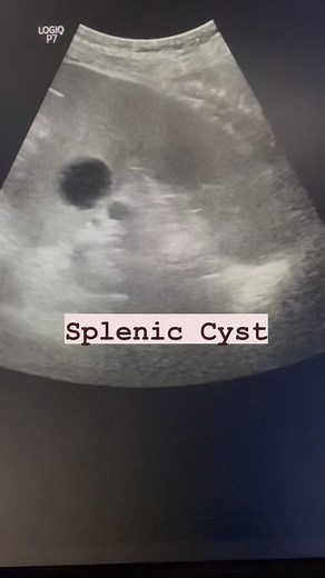 41 reactions | Splenic cyst #spleniccyst #spleenpathology #spleenultrasound #ultrasoundofspleen #radiologist #ultrasonologist #ultrasoundmadeeasy | Ultrasound made easy | Facebook