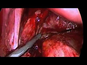 Laparoscopic Salpingectomy for Ectopic Pregnancy after Failed Methotrexate • Video • MEDtube.net