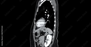 CT Abdomen show a retroperitoneal mass with a peripheral fatty component with thin septa and poorly defined solid-appearing areas with no clear demarcation between them and fat.
