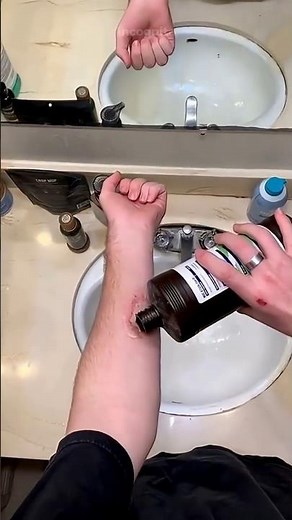 Hydrogen peroxide NEVER healed the wound... it did something WORSE