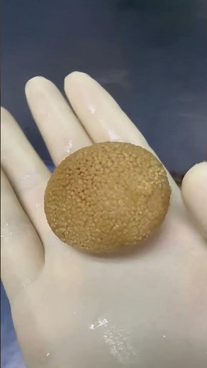 Surgery to remove stones in the bladder.