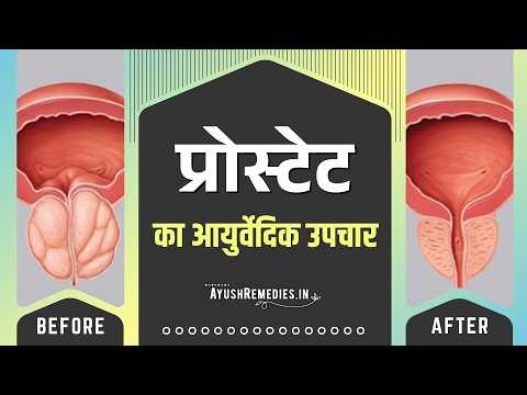 प्रोस्टेट ग्रंथि का इलाज और घरेलू उपाय | बीपीएच समस्या आयुर्वेदिक समाधान
