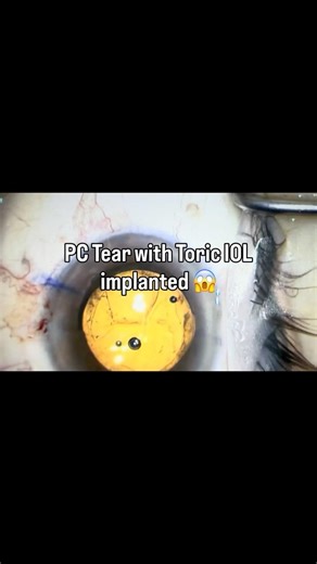 Unstable Toric with posterior capsular tear. Explant it ? #cataractsurgerymentor
