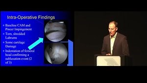 Acetabular Labral Tear in Polytrauma Patients With Continued Pain After Ipsilateral Femoral Shaft Fracture: A Report of 3 Cases