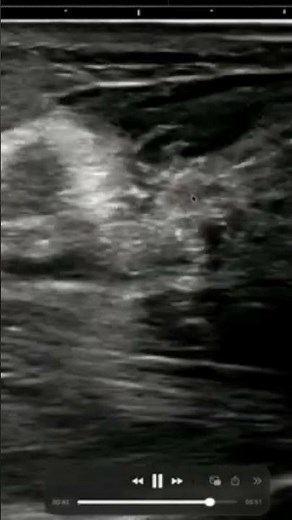 アキレス腱断裂、足首を動かすと一瞬で見えていますか？