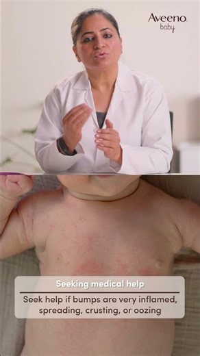 When to Worry About Baby Acne | Newborn Skincare Tips for Parents