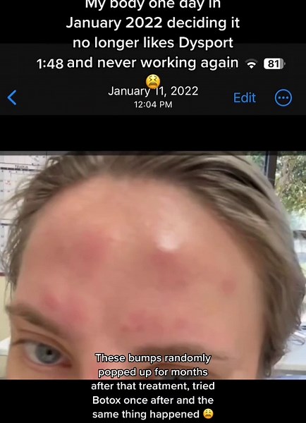 Woman shares disturbing video of bumps appearing after botox