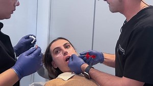 Dr. Khorasani's Under Eye Tear Trough Augmentation with Dermal Filler