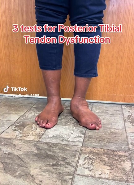 3 tests for Posterior Tibial Tendon Dysfunction #sportsmed #sportsmedicine #residency #caqsm #familymedicine #medstudent #medicalstudents #premedstudent #premedlife #orthopedics #flatfeet #anklepain #posteriortibialtendonitis #ankletendonitis #pesplanus #podiatry #podiatrist