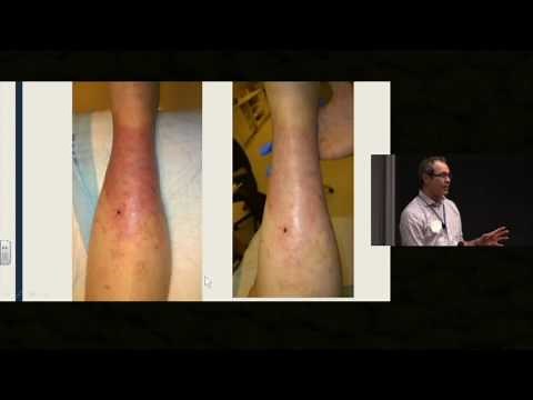 Diagnosing and Treating Cellulitis in Residential Care - Dr. Eric Partlow