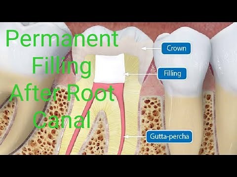 Permanent Filling after root canal #DrMaddybrown #Dental #Trending