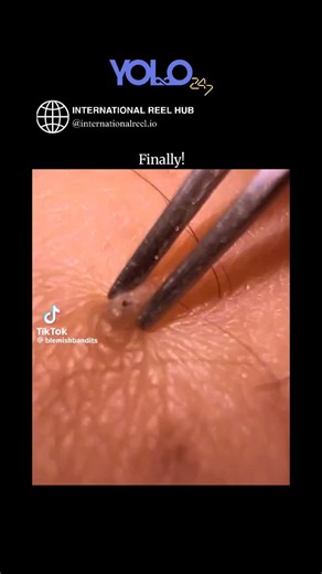 🌍 INTERNATIONAL REEL HUB | The post features a 18-second close-up video of tweezers meticulously extracting a long, embedded black hair or thread from skin on a knee,... | Instagram
